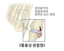 통풍성 관절염