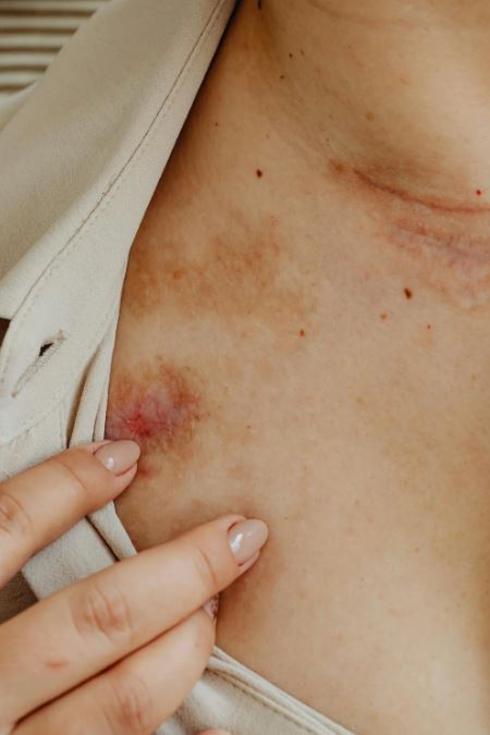 주혈흡충증 감염 과정과 부위 및 3단계 증상과 치료 방법 및 주요 유행 지역과 예방법