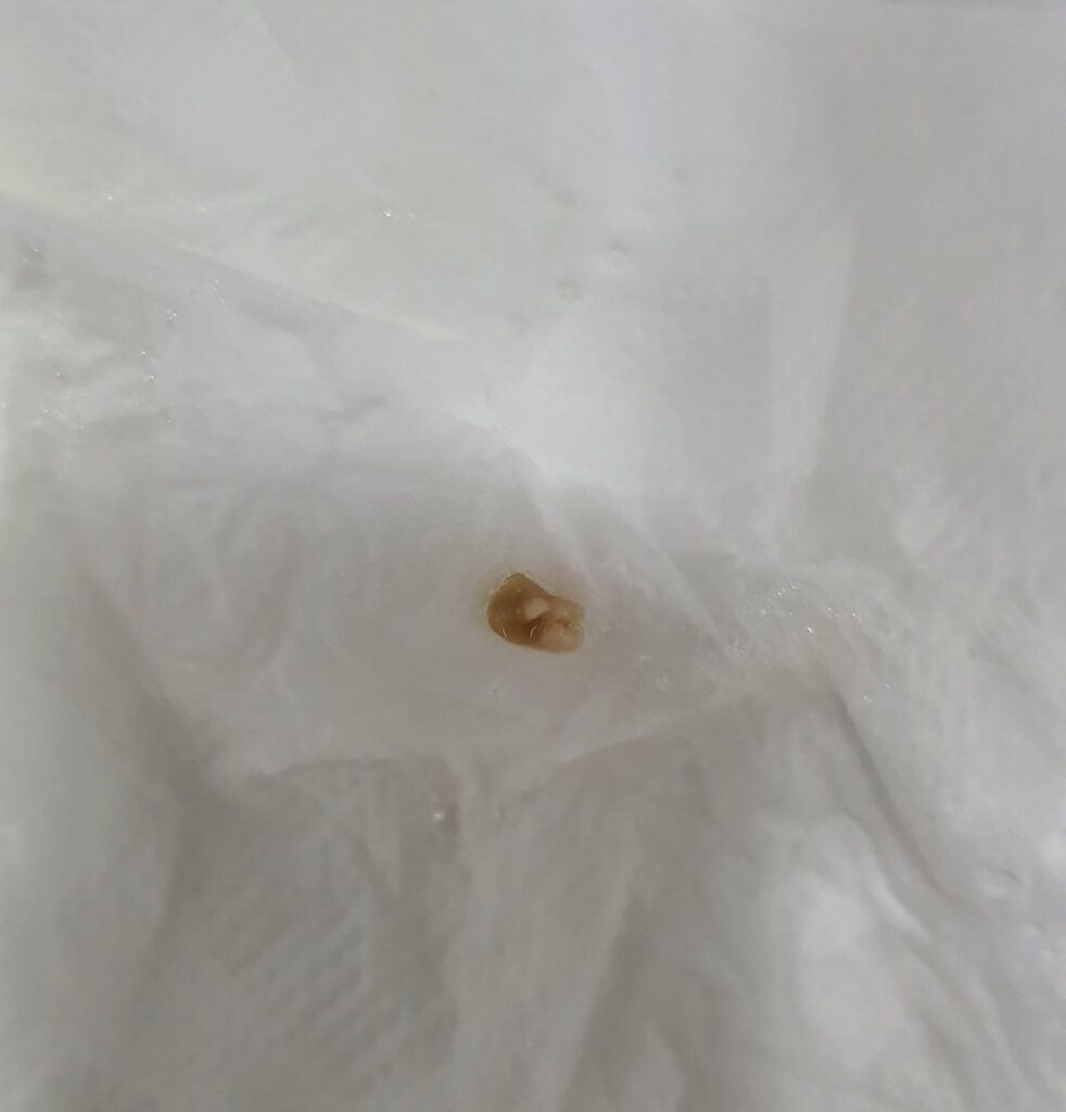 목안 편도에 생기는 작은 악취 덩어리 편도석 편도 결석의 5가지 원인과 증상 및 치료 및 관리 방법